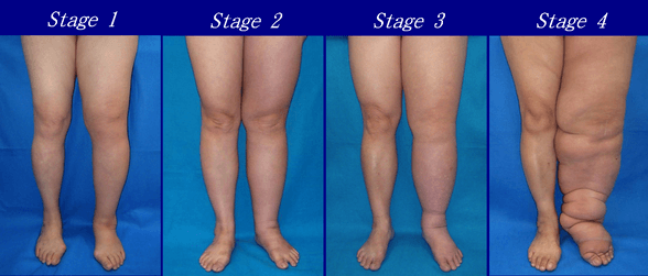 Linfedema: O Que É e Como Afeta a Qualidade de Vida