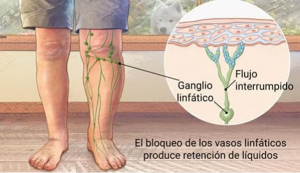 Causas do Linfedema