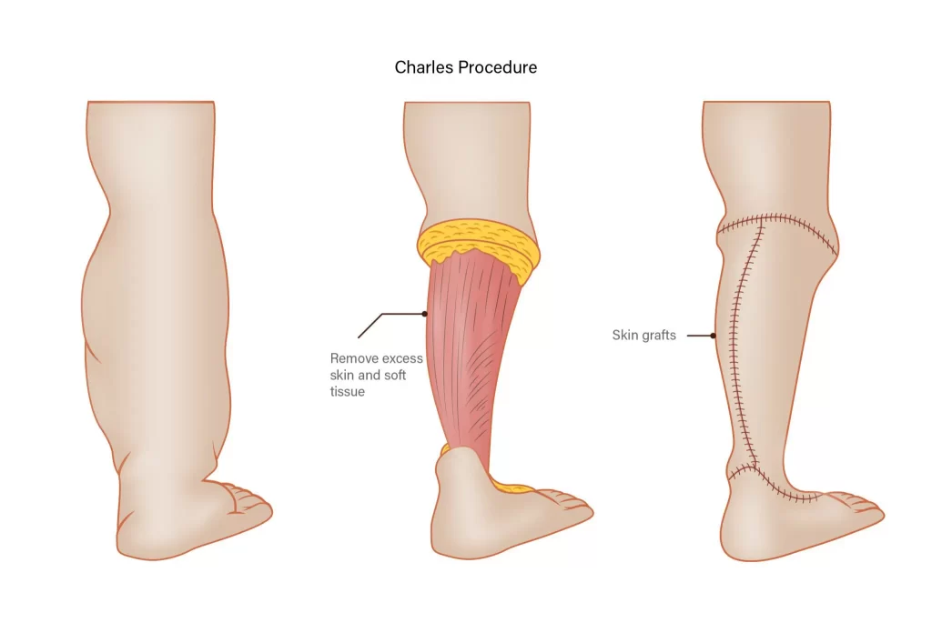 Como funciona a cirurgia linfedema