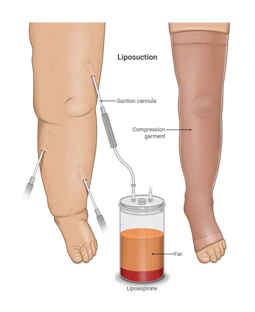 tratamento cirúrgico linfedema